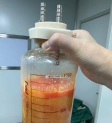 武夷山水动力吸脂手术要做多久？